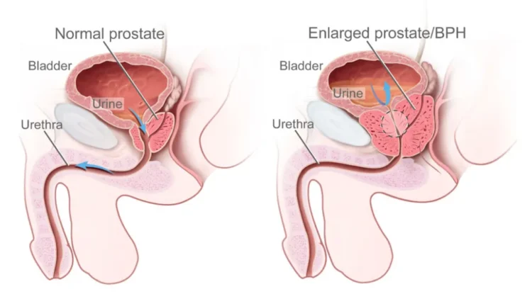 IPERTROFIA PROSTATICA BENIGNA ( IPB )